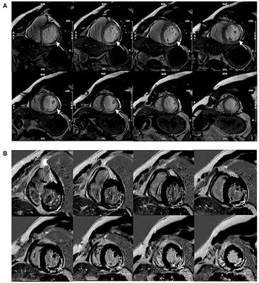 Value of Fast MVO Identification From Contrast-Enhanced Cine (CE-SSFP) Combined With Myocardial Strain in Predicting Adverse Events in Patients After ST-Elevation Myocardial Infarction